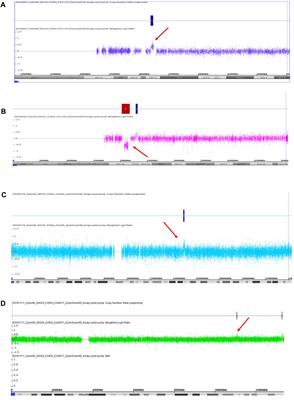 Chromosomal Microarray Analysis as First-Tier Genetic Test for Schizophrenia